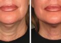 How to Tighten Neck Skin Without Surgery