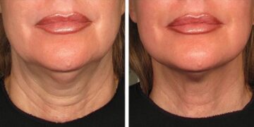 How to Tighten Neck Skin Without Surgery