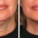 How to Tighten Neck Skin Without Surgery